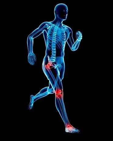 Arthritis and Joint Pain